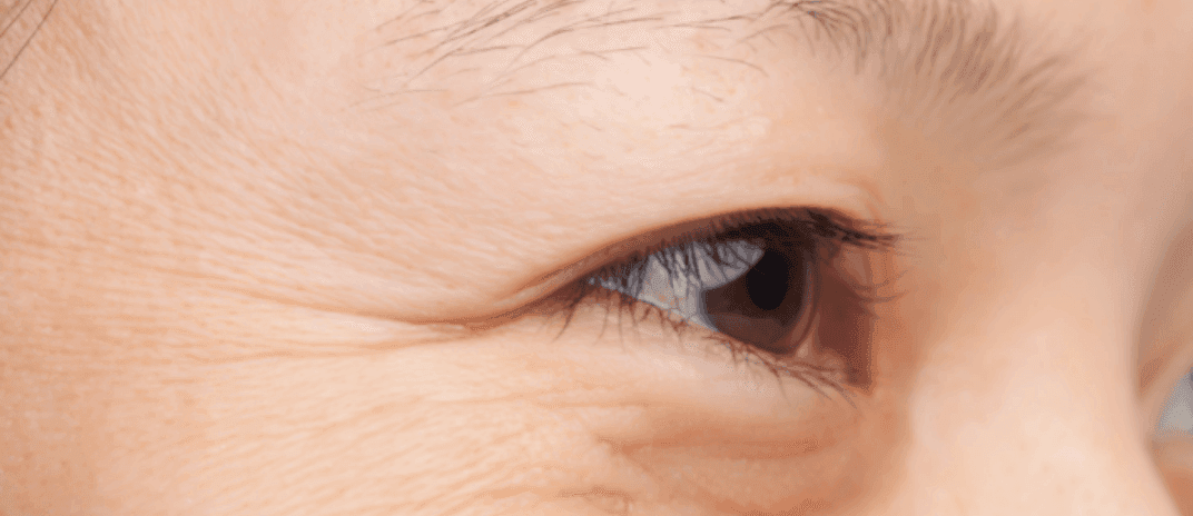 Sleep Wrinkles: 6 Ways To Prevent Them