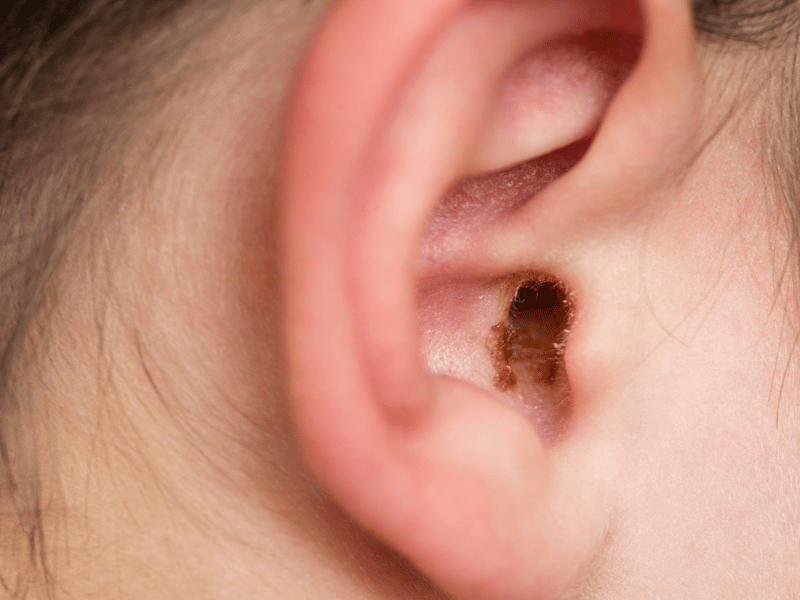 close up of ear with ear wax buildup, a risk of sleeping with earbuds