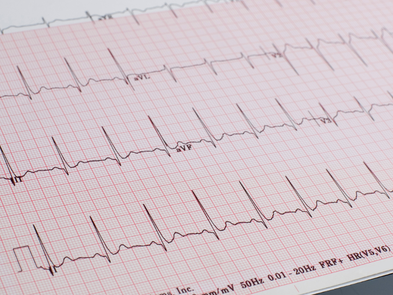 cardiac monitoring ecg 