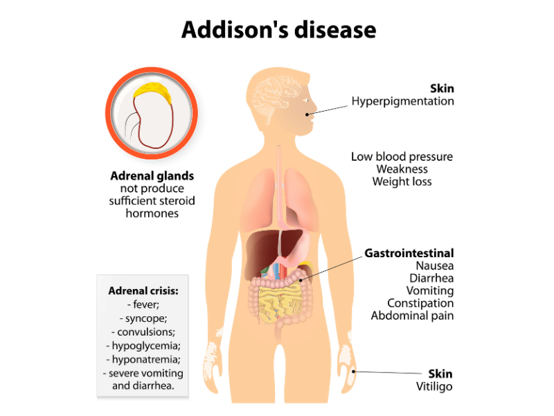 addison's disease is a result of low cortisol level as there's primary adrenal insufficiency