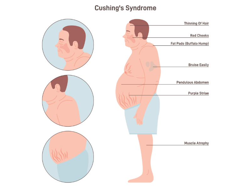 hypercortisolism or high cortisol levels can result in cushing's syndrome