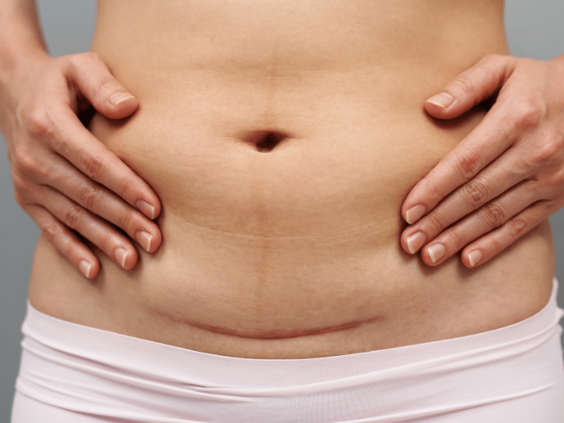 A woman poses with her stomach exposed after c-section