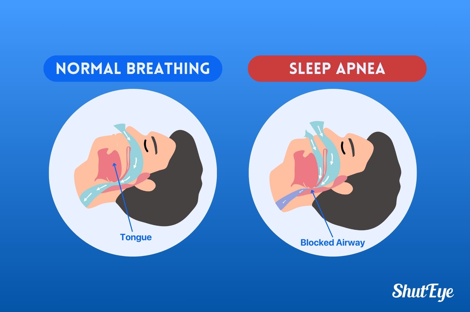 Sleep Apnea : Symptoms, Causes, Diagnosis and Treatment ShutEye