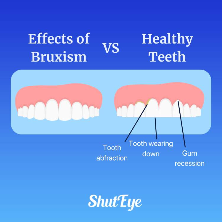 effects of Bruxism