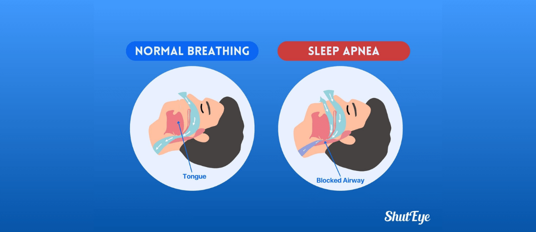 Sleep Apnea : Symptoms, Causes, Diagnosis and Treatment