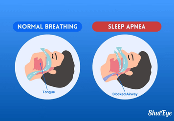 Sleep Apnea : Symptoms, Causes, Diagnosis and Treatment