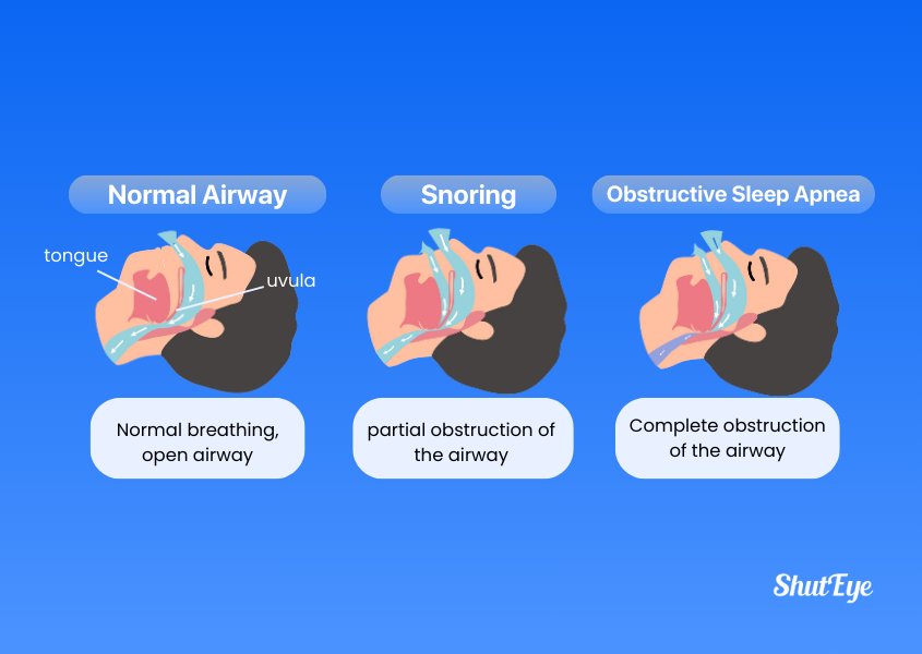 There are 3 types of snoring: normal airway, snoring, obstructive sleep apnea